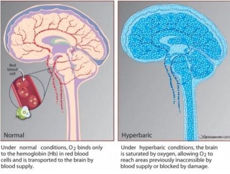 HBOT and brain health